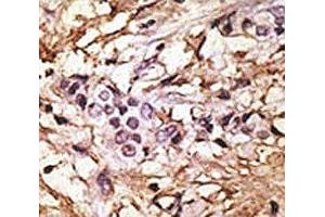 IHC analysis of FFPE human breast carcinoma tissue stained with the LC3 II antibody