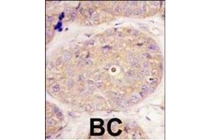 Formalin-fixed and paraffin-embedded human breast carcinoma tissue reacted with GGPS1 Antibody (C-term)((ABIN389056 and ABIN2839265)), which was peroxidase-conjugated to the secondary antibody, followed by DAB staining. (GGPS1 抗体  (C-Term))