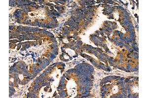 ABIN6256896 and ABIN6274454 at 1/100 staining Human colorectal cancer by IHC-P.
