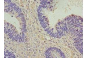 Immunohistochemistry of paraffin-embedded human ovarian cancer using ABIN7175357 at dilution of 1:100 (Vangl1 抗体  (AA 275-524))