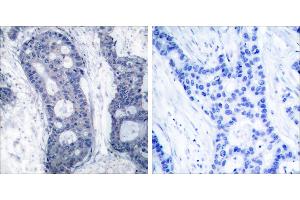 Peptide - +Immunohistochemical analysis of paraffin-embedded human breast carcinoma tissue using elF4E (Ab-209) antibody (#B7067). (EIF4E 抗体  (Ser209))