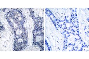 Peptide - +Immunohistochemical analysis of paraffin-embedded human breast carcinoma tissue using elF4E (Ab-209) antibody (#B7067).