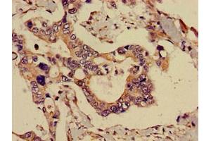 Immunohistochemistry of paraffin-embedded human pancreatic cancer using ABIN7143291 at dilution of 1:100 (ADK 抗体  (AA 18-256))