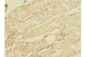 Immunohistochemistry of paraffin-embedded human gastric cancer using ABIN7146298 at dilution of 1:100 (CALHM3 抗体  (AA 201-350))
