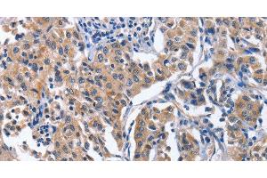 Immunohistochemistry of paraffin-embedded Human lung cancer tissue using INTS10 Polyclonal Antibody at dilution 1:50 (INTS10 抗体)