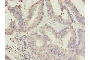 Immunohistochemistry of paraffin-embedded human endometrial cancer using ABIN7174707 at dilution of 1:100