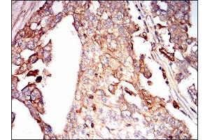 Immunohistochemical analysis of paraffin-embedded ovarian cancer tissues using SDC1 mouse mAb with DAB staining. (Syndecan 1 抗体  (AA 28-171))
