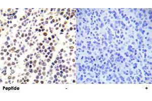 Immunohistochemical analysis of paraffin-embedded human malignant lymphoma tissue using HIST1H3E (phospho S28) polyclonal antibody . (HIST1H3E 抗体  (pSer28))