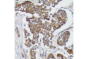 Immunohistochemistry of paraffin-embedded human breast cancer using FERMT2 Rabbit pAb (ABIN6131926, ABIN6140582, ABIN6140583 and ABIN6224757) at dilution of 1:300 (40x lens). (FERMT2 抗体  (AA 380-550))