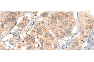 Immunohistochemistry of paraffin-embedded Human esophagus cancer tissue using GPR55 Polyclonal Antibody at dilution of 1:40(x200) (GPR55 抗体)