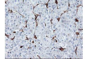 Immunohistochemical staining of paraffin-embedded Carcinoma of Human liver tissue using anti-BCAT1 mouse monoclonal antibody. (BCAT1 抗体)