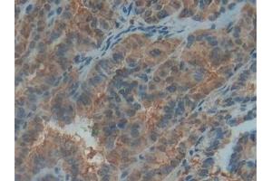 Detection of PDGF BB in Human Thyroid cancer Tissue using Polyclonal Antibody to Platelet Derived Growth Factor BB (PDGF BB) (PDGF-BB Homodimer (AA 82-190) 抗体)