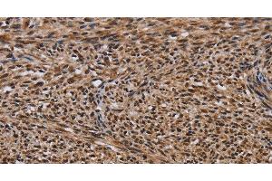 Immunohistochemistry of paraffin-embedded Human sarcoma using KIF1C Polyclonal Antibody at dilution of 1:60 (KIF1C 抗体)