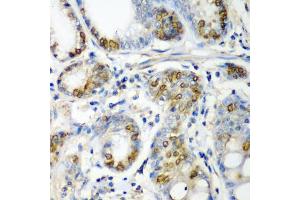 Immunohistochemistry of paraffin-embedded human colon carcinoma using CRYAA antibody (ABIN5973354) at dilution of 1/200 (40x lens). (CRYAA 抗体)