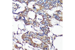 Immunohistochemistry of paraffin-embedded Human colon carcinoma using SLIRP Rabbit pAb (ABIN7270560) at dilution of 1:100 (40x lens). (SLIRP 抗体  (AA 1-100))