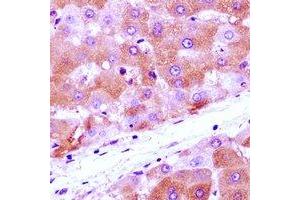 Immunohistochemical analysis of Anamorsin staining in human liver cancer formalin fixed paraffin embedded tissue section. (CIAPIN1 抗体)