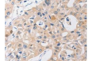 The image on the left is immunohistochemistry of paraffin-embedded Human lung cancer tissue using ABIN7191756(P2RY11 Antibody) at dilution 1/40, on the right is treated with synthetic peptide.