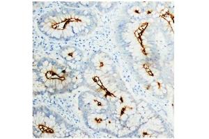 Immunohistochemistry (IHC) image for anti-Carcinoembryonic Antigen-Related Cell Adhesion Molecule 5 (CEACAM5) antibody (ABIN1106531)