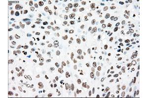 Immunohistochemical staining of paraffin-embedded Adenocarcinoma of colon tissue using anti-PLK1mouse monoclonal antibody. (PLK1 抗体)
