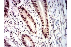 Immunohistochemical analysis of paraffin-embedded rectum cancer tissues using RBBP7 mouse mAb with DAB staining. (RBBP7 抗体  (AA 1-200))
