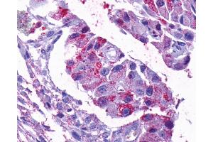 Anti-OPN5 antibody IHC of human Ovary, Carcinoma. (OPN5 抗体  (C-Term))