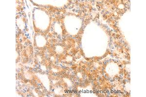 Immunohistochemistry of Human thyroid cancer using NAP1L1 Polyclonal Antibody at dilution of 1:70 (NAP1L1 抗体)