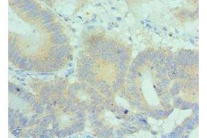 Immunohistochemistry of paraffin-embedded human colon cancer using ABIN7169161 at dilution of 1:100 (PLK2 抗体  (AA 336-685))
