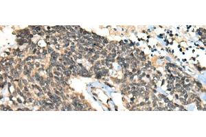 Immunohistochemistry of paraffin-embedded Human lung cancer tissue using CCNB1IP1 Polyclonal Antibody at dilution of 1:30(x200) (CCNB1IP1 抗体)
