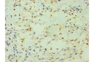 Immunohistochemistry of paraffin-embedded human breast cancer using ABIN7163201 at dilution of 1:100 (PIP4K2B 抗体  (AA 1-270))