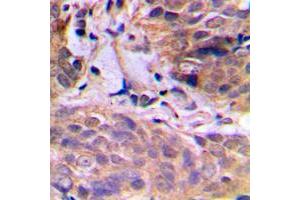 Immunohistochemical analysis of HuB staining in human breast cancer formalin fixed paraffin embedded tissue section. (HuB (Center) 抗体)