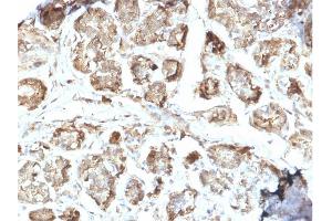 Formalin-fixed, paraffin-embedded human Breast Carcinoma stained with NME2 / nm23-H2 Mouse Monoclonal Antibody (CPTC-NME2-2). (NME2 抗体)