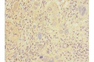 Immunohistochemistry of paraffin-embedded human liver cancer using ABIN7146045 at dilution of 1:100 (C-Type Lectin Domain Family 1, Member B (CLEC1B) (AA 55-229) 抗体)