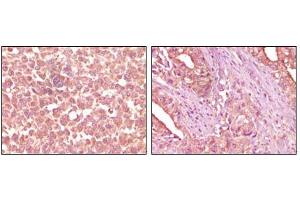 Immunohistochemical analysis of paraffin-embedded human skin carcinoma (left) and pancreas carcinoma (right) tissue, showing cytoplasmic localization using EphA2 mouse mAb with DAB staining.