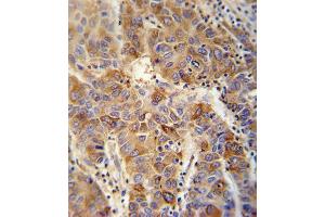 VP4 antibody (Center) (ABIN652042 and ABIN2840516) immunohistochemistry analysis in formalin fixed and paraffin embedded human hepatocarcinoma followed by peroxidase conjugation of the secondary antibody and DAB staining. (VAMP4 抗体  (AA 16-45))