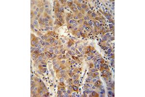 VP4 antibody (Center) (ABIN652042 and ABIN2840516) immunohistochemistry analysis in formalin fixed and paraffin embedded human hepatocarcinoma followed by peroxidase conjugation of the secondary antibody and DAB staining. (VAMP4 抗体  (AA 16-45))