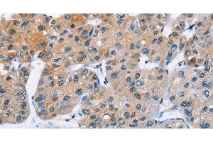 Immunohistochemistry of paraffin-embedded Human liver cancer using ATXN1 Polyclonal Antibody at dilution of 1:40 (Ataxin 1 抗体)