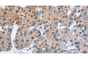 Immunohistochemistry of paraffin-embedded Human liver cancer using ATXN1 Polyclonal Antibody at dilution of 1:40 (Ataxin 1 抗体)