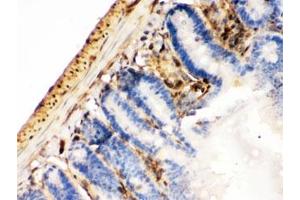 IHC testing of FFPE mouse intestinal cancer with Galectin 1 antibody. (LGALS1/Galectin 1 抗体  (AA 2-135))