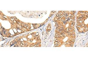Immunohistochemistry of paraffin-embedded Human gastric cancer tissue using NOL8 Polyclonal Antibody at dilution of 1:40(x200) (NOL8 抗体)