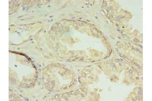 Immunohistochemistry of paraffin-embedded human prostate cancer using ABIN7147537 at dilution of 1:100 (CHMP7 抗体  (AA 1-290))