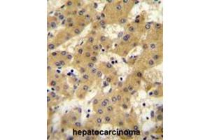 APOF antibody (Center) immunohistochemistry analysis in formalin fixed and paraffin embedded human hepatocarcinoma followed by peroxidase conjugation of the secondary antibody and DAB staining. (Apolipoprotein F 抗体  (Middle Region))
