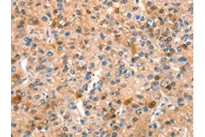 The image on the left is immunohistochemistry of paraffin-embedded Human liver cancer tissue using ABIN7192636(SPRN Antibody) at dilution 1/15, on the right is treated with synthetic peptide. (SPRN 抗体)