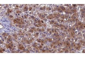 ABIN6276852 at 1/100 staining Human liver cancer tissue by IHC-P. (PTH1R 抗体  (pThr1))