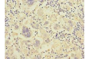 Immunohistochemistry of paraffin-embedded human liver cancer using ABIN7156498 at dilution of 1:100 (Integrin beta 7 抗体  (AA 1-140))