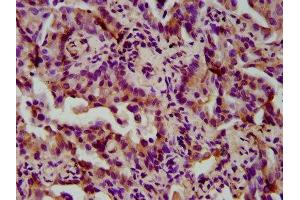 IHC image of ABIN7166187 diluted at 1:300 and staining in paraffin-embedded human lung cancer performed on a Leica BondTM system. (TIMELESS 抗体  (AA 1004-1131))