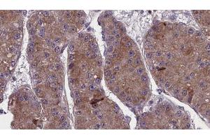 ABIN6272757 at 1/100 staining Human liver cancer tissue by IHC-P. (OR13C5 抗体  (C-Term))
