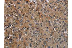 The image on the left is immunohistochemistry of paraffin-embedded Human liver cancer tissue using ABIN7129423(FAAH Antibody) at dilution 1/50, on the right is treated with fusion protein. (FAAH 抗体)