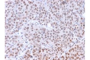 Formalin-fixed, paraffin-embedded human Colon Carcinoma stained with RNA Polymerase II / Poll II Mouse Monoclonal Antibody (8A7). (POLR2A/RPB1 抗体  (pSer5))