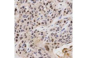 Immunohistochemistry of paraffin-embedded human esophageal cancer using KPNA4 Antibody (ABIN5971058) at dilution of 1/200 (40x lens). (KPNA4 抗体)