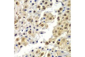 Immunohistochemistry of paraffin-embedded human liver cancer using SYNCRIP antibody. (SYNCRIP 抗体  (AA 1-200))